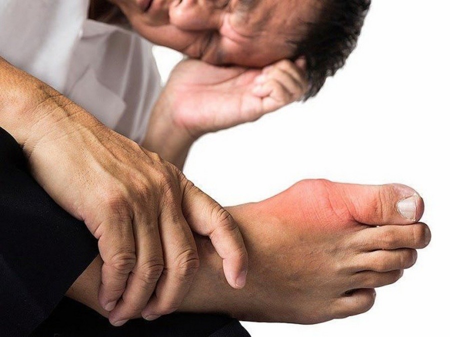 Tăng axit uric trong máu do rượu bia là nguyên nhân chính gây ra bệnh gout